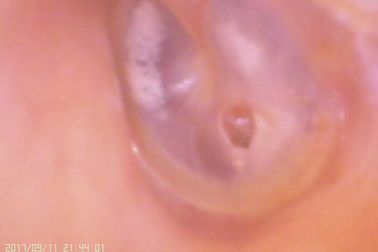 Tympanic膜のパーホレーションのためのビデオ耳および鼻CのameraのデジタルOtoscope
