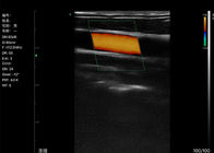 エコーの手持ち型色のドップラー線形スキャン頸動脈7.5-10MHzの頻度