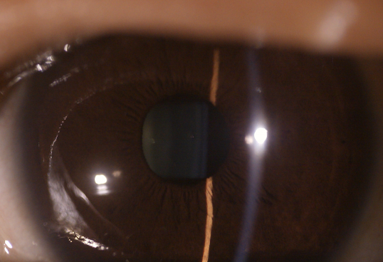 3レンズ取り替え可能な利用できる眼装置のデジタルFundusのカメラの目の表面のカメラの目の前方レンズ