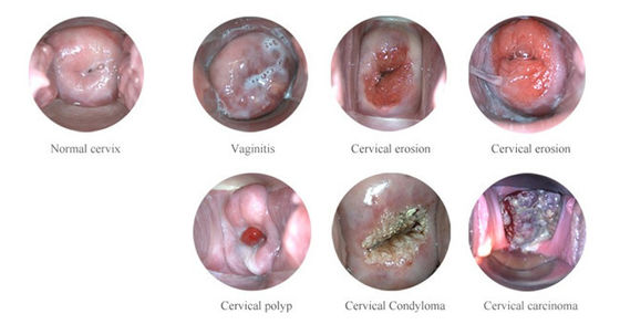 ポータブル デジタル 電子 コルポスコップ