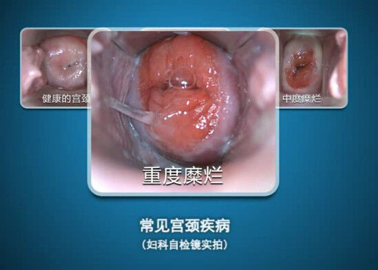 デジタル内視鏡は観察70~100mmの範囲とのColposcopeの小型コルポスコピーを自己点検します