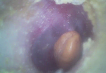 携帯用ENT規模の32GのマイクロSDのフラッシュ カードが付いている経済的な手持ち型のデジタル ビデオOtoscope